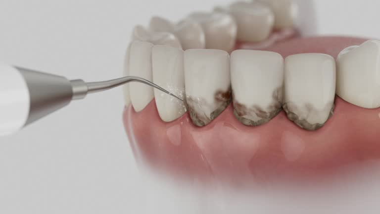 Trusted Wisdom Tooth Removal service in Wolfhurst, OH - Dentist Open Now